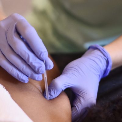 Andrea Álvarez fisioterapeuta en fisioterapia velázquez realizando una sesión de punción seca