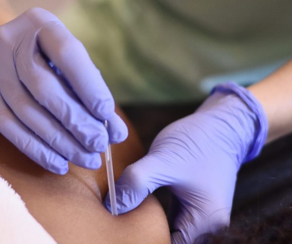 Andrea Álvarez fisioterapeuta en fisioterapia velázquez realizando una sesión de punción seca
